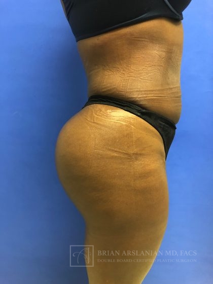 Brazilian Butt Lift case #2206