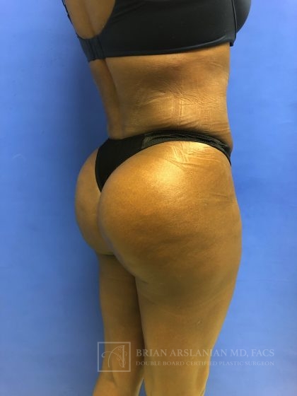 Brazilian Butt Lift case #2206