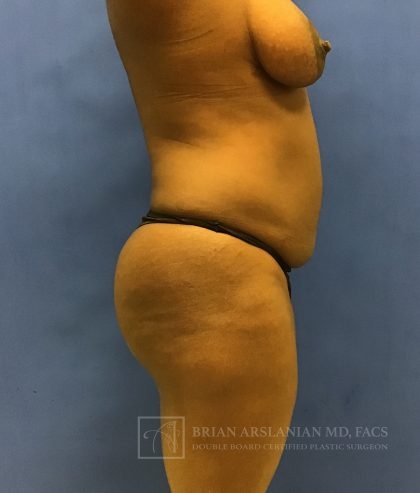 Brazilian Butt Lift case #2206