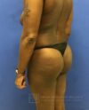 Brazilian Butt Lift case #2206