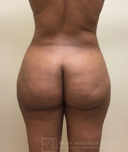 Brazilian Butt Lift case #2219