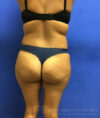 Brazilian Butt Lift case #2247