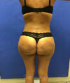 Brazilian Butt Lift case #2247