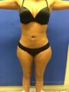 Brazilian Butt Lift case #2247