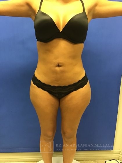 Brazilian Butt Lift case #2247