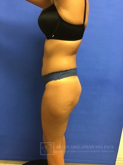 Brazilian Butt Lift case #2247