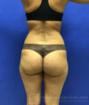 Brazilian Butt Lift case #2256