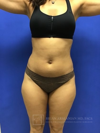 Brazilian Butt Lift case #2256