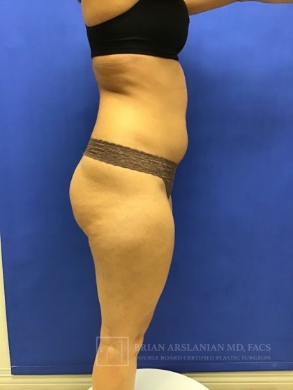 Brazilian Butt Lift case #2256