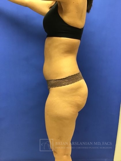 Brazilian Butt Lift case #2256