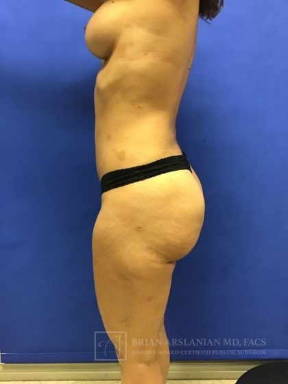 Brazilian Butt Lift case #2256