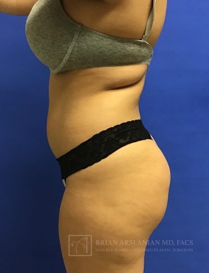 Brazilian Butt Lift case #2138