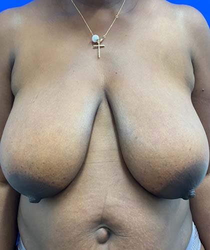 Breast Reduction case #5370