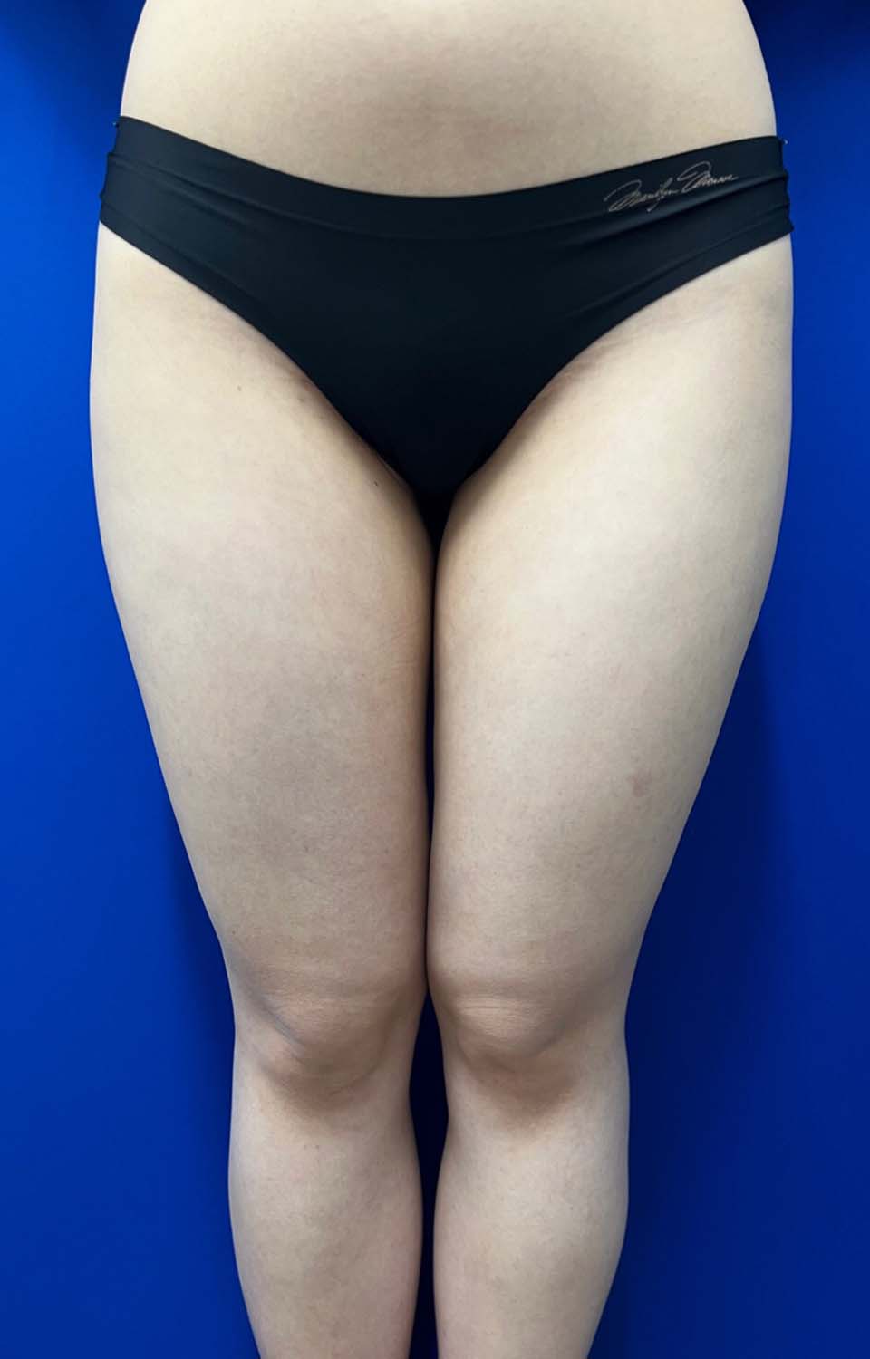 Liposuction case #5413