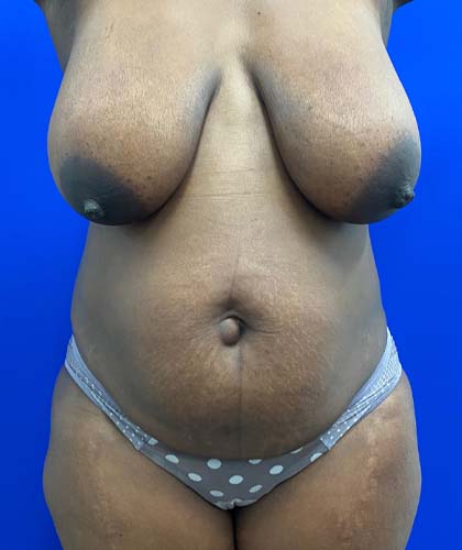 Liposuction case #5381