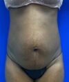 Liposuction case #5391