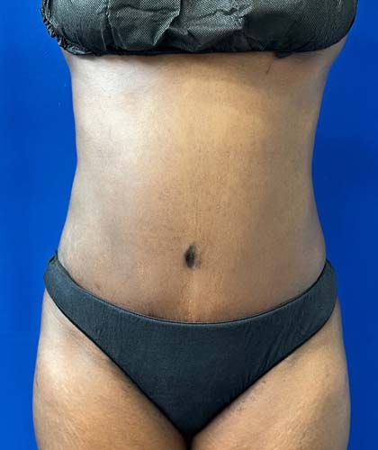 Liposuction case #5391