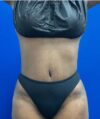 Liposuction case #5381