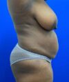 Liposuction case #5381