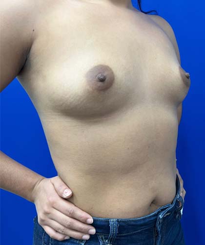 Breast Augmentation case #5402