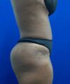 Liposuction case #5381