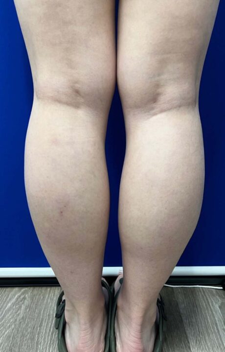 Liposuction case #5413