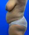 Liposuction case #5381