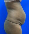 Liposuction case #5391