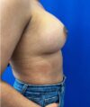 Breast Augmentation case #5402