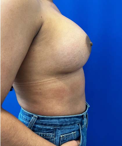 Breast Augmentation case #5402