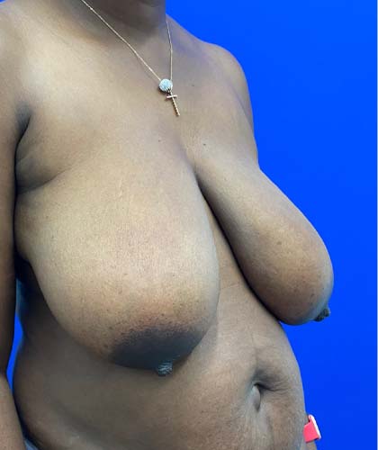 Breast Reduction case #5370