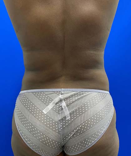 Liposuction case #5381