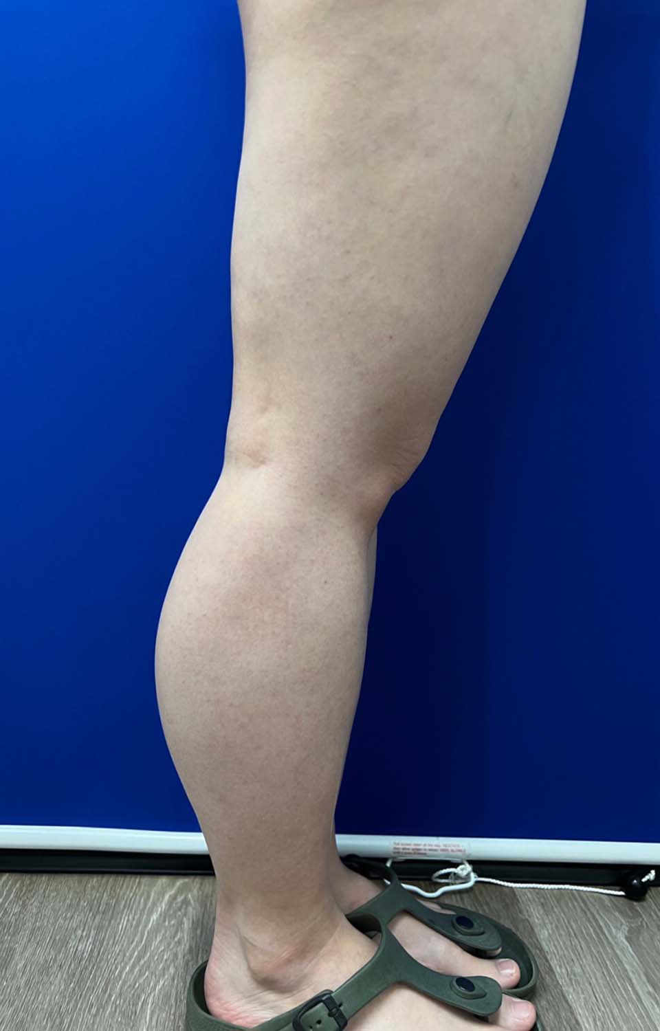 Liposuction case #5413