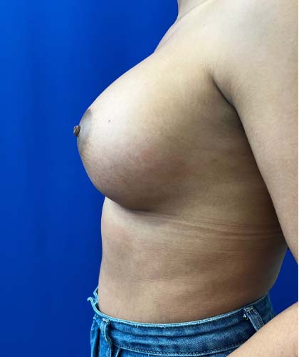 Breast Augmentation case #5402