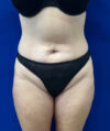 Liposuction case #6851
