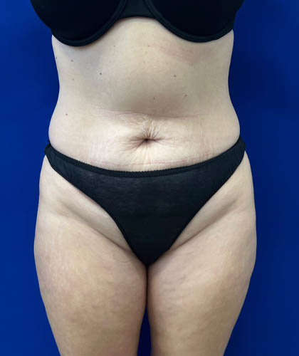 Liposuction case #6851