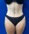 Liposuction case #6851