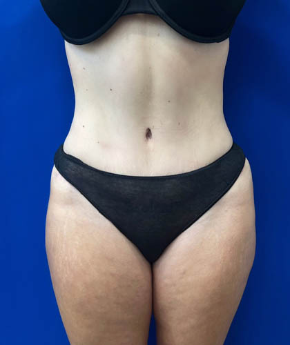 Liposuction case #6851