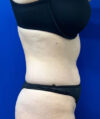Liposuction case #6851