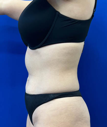 Liposuction case #6851