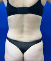 Liposuction case #6851