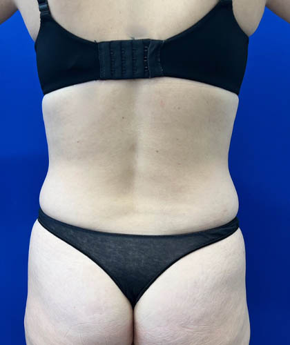 Liposuction case #6851