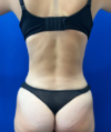Liposuction case #6851