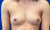 Female To Male case #7852