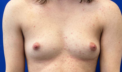 Female To Male case #7852