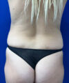 Tummy Tuck case #7873