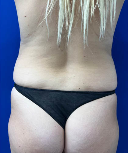 Tummy Tuck case #7873