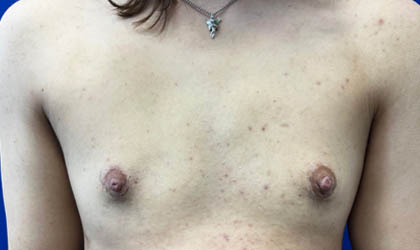 Female To Male case #7852