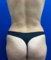Tummy Tuck case #7873