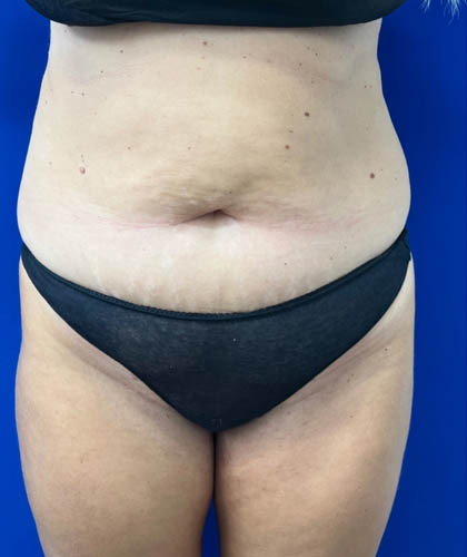 Tummy Tuck case #7873